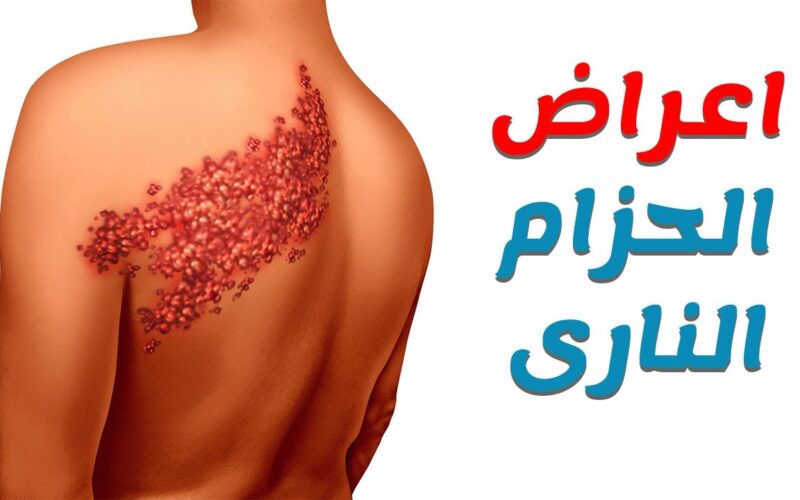 5 أكلات ممنوعة لمريض الحزام الناري بعد توفير التطعيم في مصر