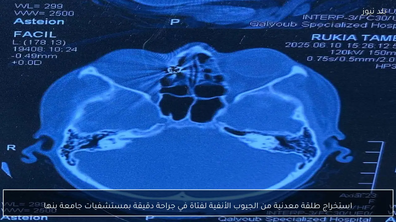 استخراج طلقة معدنية من الجيوب الأنفية لفتاة في جراحة دقيقة بمستشفيات جامعة بنها