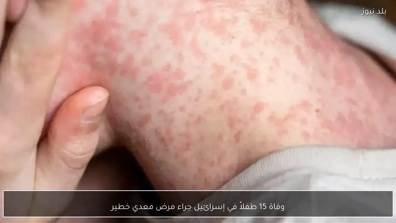 وفاة 15 طفلاً في إسرائيل جراء مرض معدي خطير