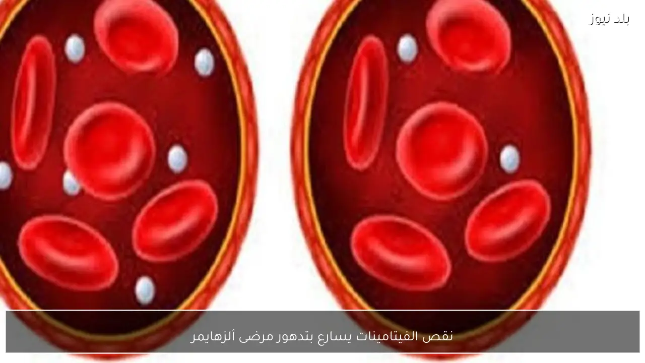 نقص الفيتامينات يسارع بتدهور مرضى ألزهايمر